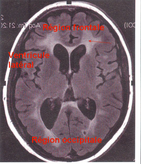 IRM cerveau axiale
